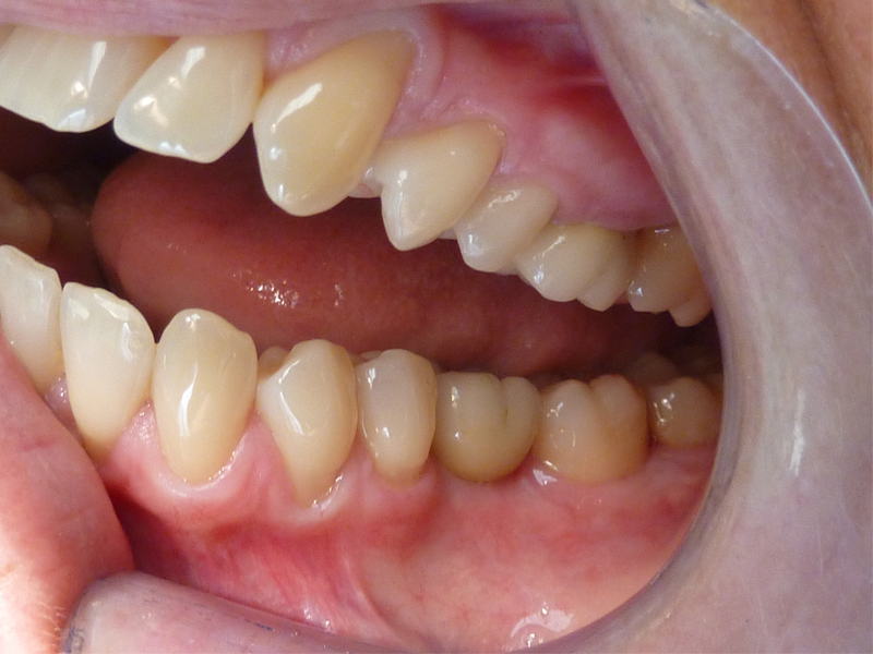 Couronne dentaire molaire en haut, couronne dentaire molaire sur implant en bas - Après