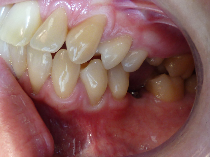 Couronne dentaire molaire en haut, couronne dentaire molaire sur implant en bas - Avant