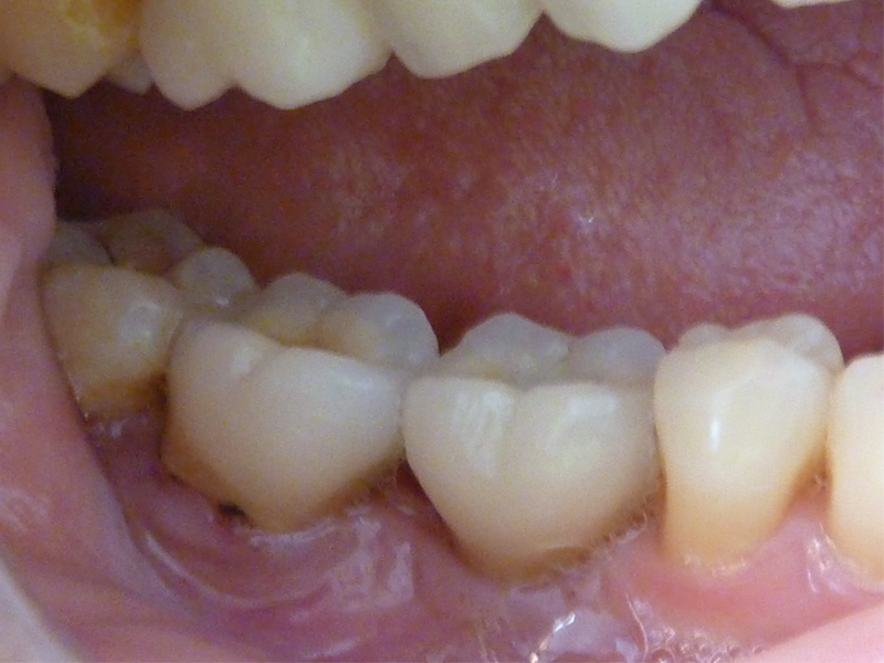 Couronne molaire sur dent et couronne molaire sur implant - Après