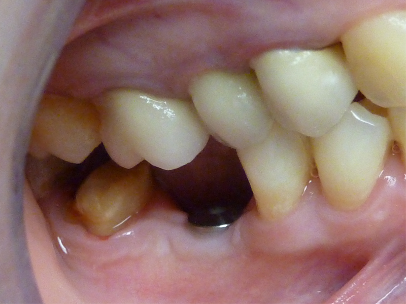 Couronne molaire sur dent et couronne molaire sur implant - Avant