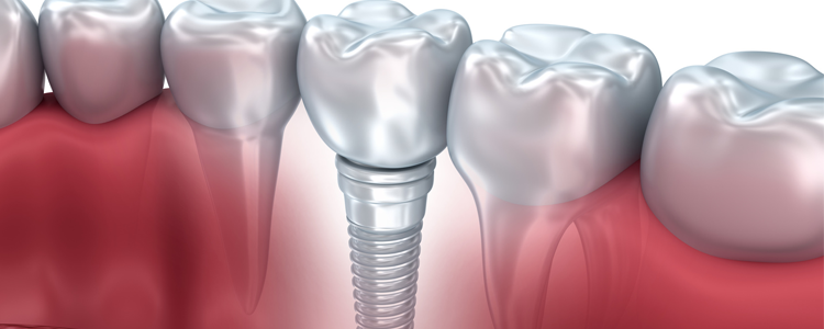 Implants Dentaires Le Bouscat