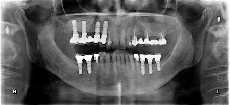 Panoramique dentaire après pose d'implants et réhabilitation prothétique