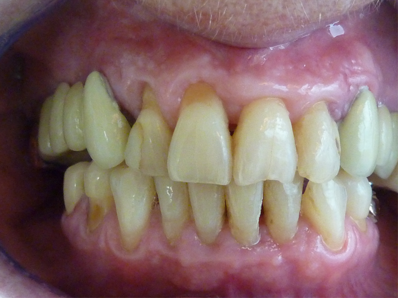 Pose d'implants, réalisation de bridges sur dents et sur implants - Avant