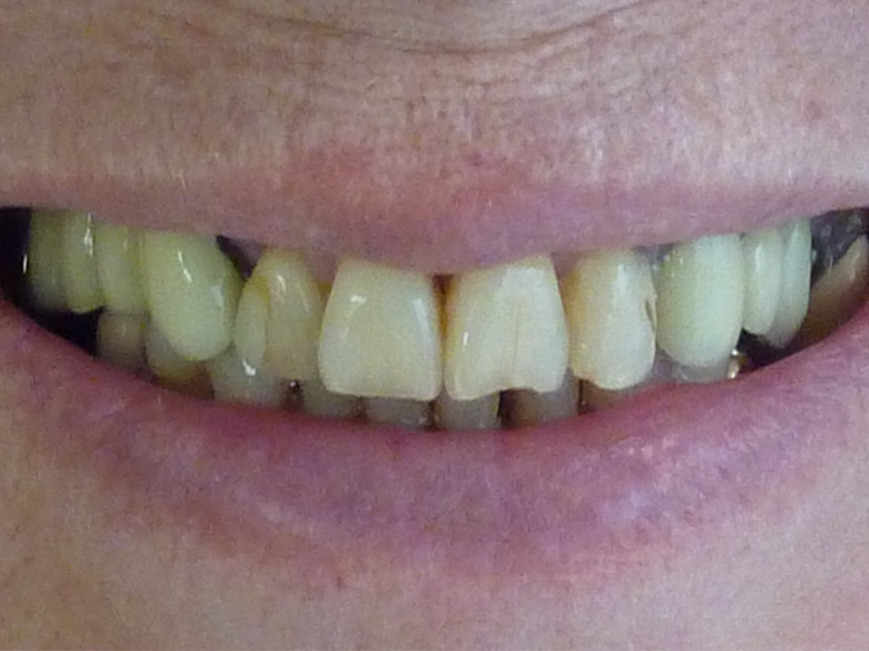 Pose d'implants, réalisation de bridges sur dents et sur implants - Avant