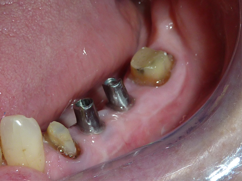 Réalisations de couronnes sur dents et sur implants - Avant